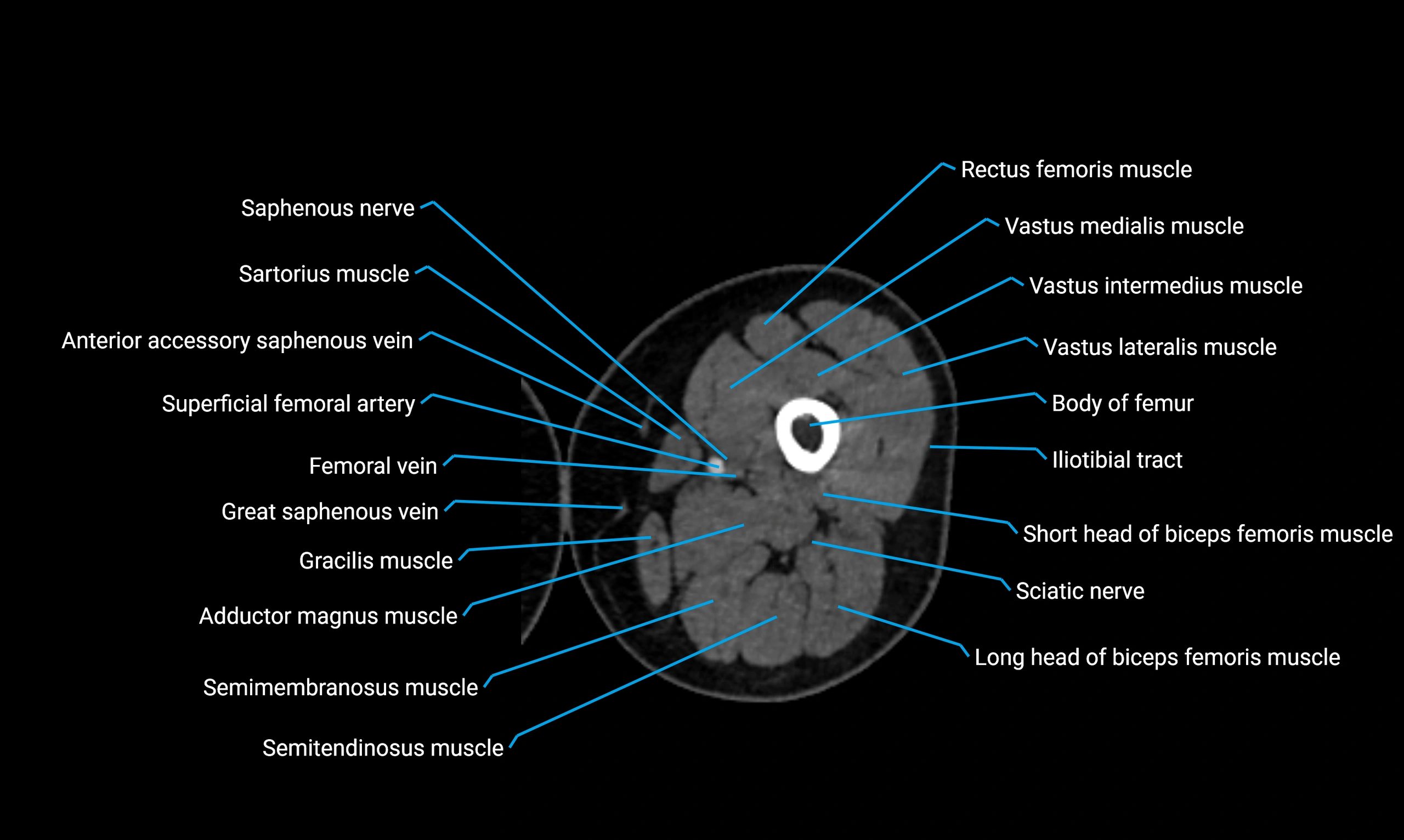 CT lower limb axial cross sectional anatomy labelled image 53 (2).webp
